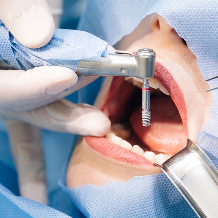 Surgeons placing a dental implant in a patient’s mouth