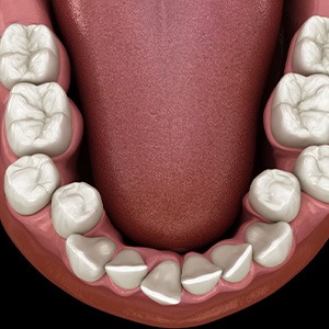 Illustration of crooked teeth
