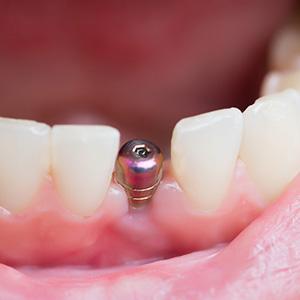 A closeup of a single tooth implant’s abutment