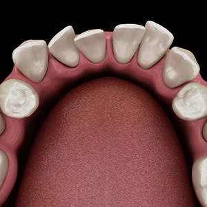Illustration of gapped teeth