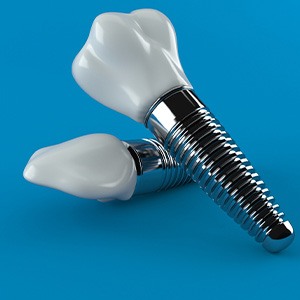 Dental implants on a blue background
