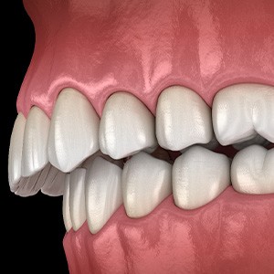 Illustration of an overbite