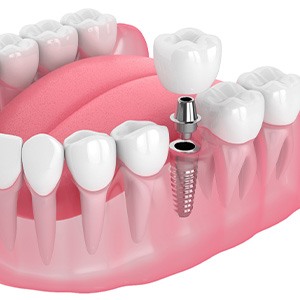 Illustration of a single dental implant