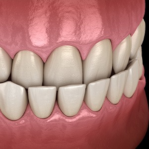 Illustration of an underbite