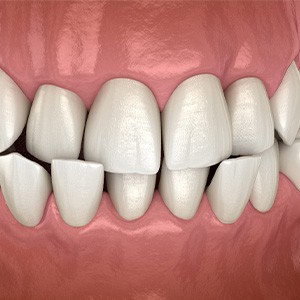 Illustration of a crossbite
