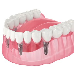 Illustration of an implant denture