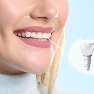 A photo highlighting a woman’s completed dental implant