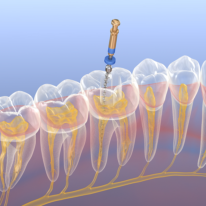 Illustration of a dental instrument performing root canal treatment on the inside of a tooth