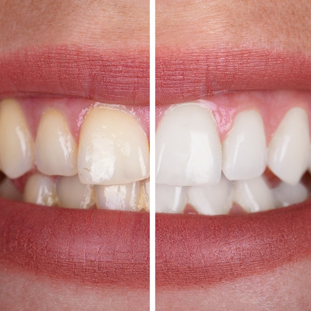Patient's smile before and after teeth whitening